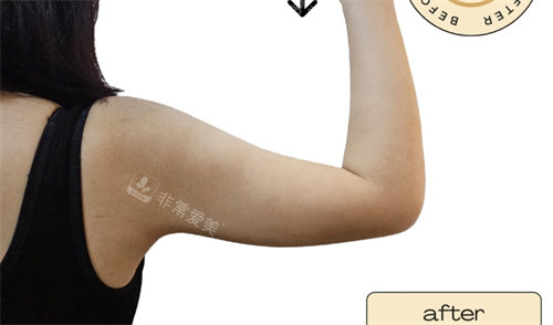 韩国清潭jasmine line clinic手臂塑型后