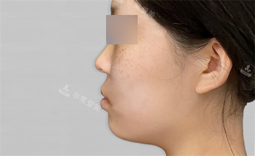 韓國macs口腔頜面外科凸嘴手術(shù)術(shù)前圖