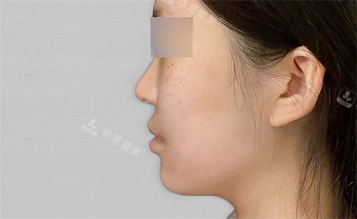 韩国macs口腔颌面外科凸嘴手术术后图