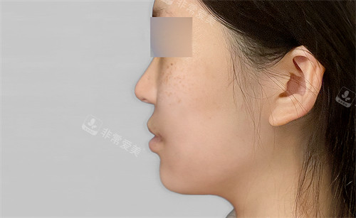 韓國macs口腔頜面外科凸嘴手術(shù)術(shù)后圖