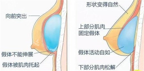 內窺鏡隆胸