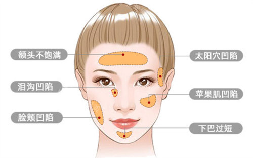 面部脂肪填充適應癥