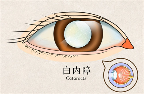 白内障动画图