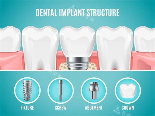 种植牙植体组成部分展示