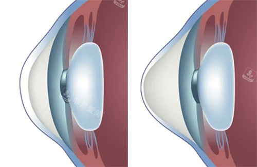 正常角膜和圆锥角膜