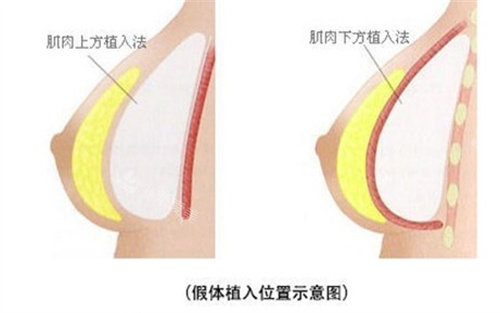 假体植入位置