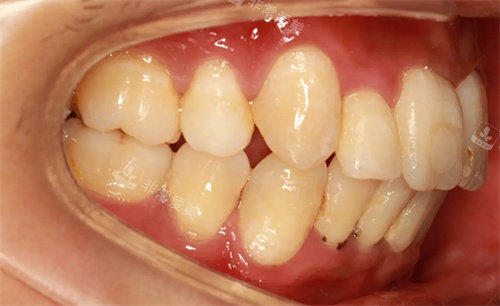 需要矫正的牙齿照片 (2)