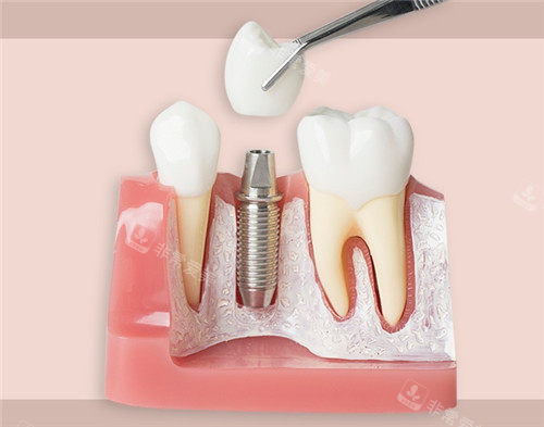 种植牙模具图片