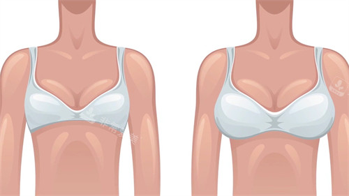 隆胸前后的对比图