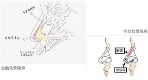 全肋和半肋隆鼻的区别图解