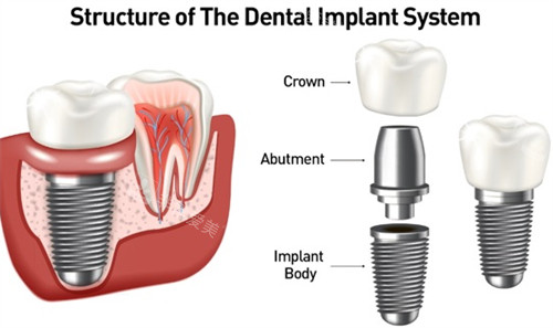 种植牙的样子图解