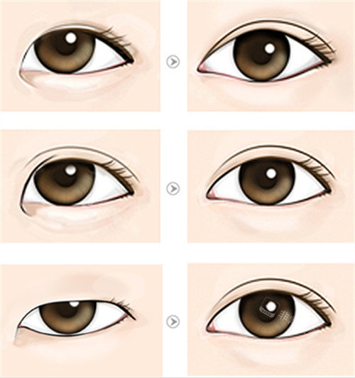 不同眼型双眼皮手术前后对比图