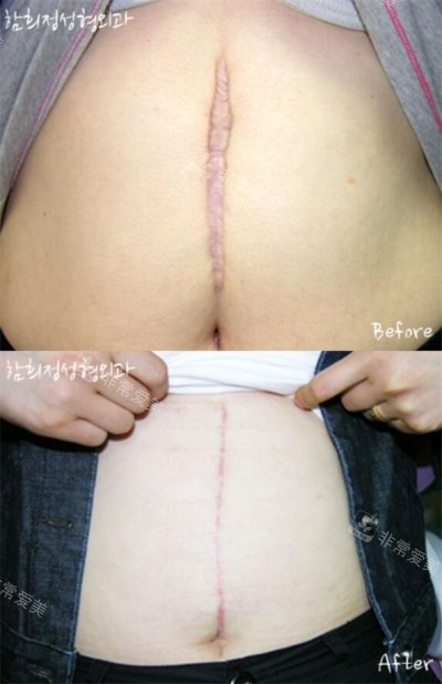 韩国Dr.ham's整形医院刨宫产疤痕治疗照片