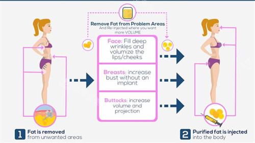 自体脂肪可以填充胸部