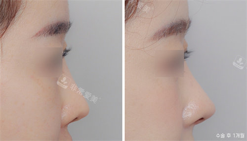 韩国nplus整形隆鼻前后侧面对比图