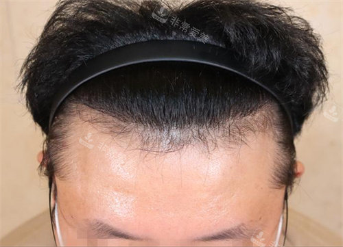 韓國永長植發(fā)醫(yī)院發(fā)際線種植術(shù)后 韓國永長植發(fā)醫(yī)院發(fā)際線種植術(shù)后