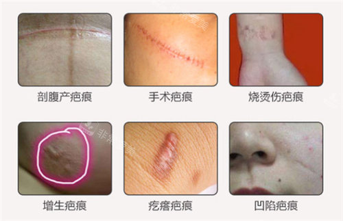 不同類型疤痕圖片 不同類型疤痕圖片