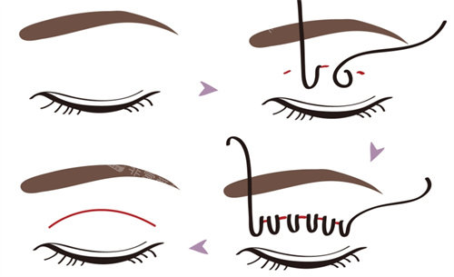 双眼皮动画图