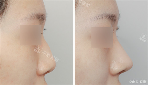 韩国nplus整形外科侧面鼻综合手术前后对比图