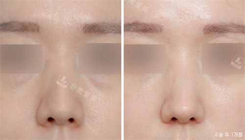 韩国nplus整形外科正面鼻综合手术前后对比图