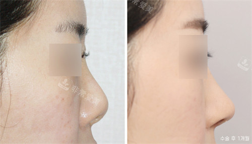韩国nplus整形外科鼻整形前后对比图