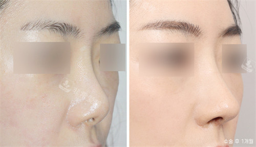 韩国nplus整形外科鼻整形手术对比图