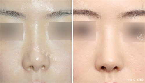 韩国nplus整形外科鼻部矫正前后对比图