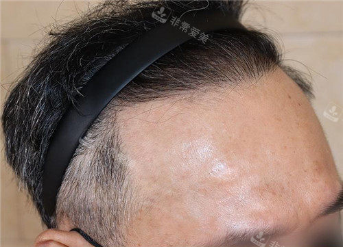 韩国永长植发男士植发后照片