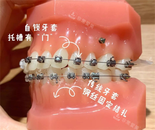 自锁牙套和金属牙套
