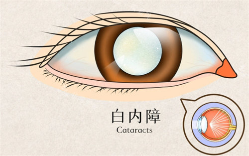 白内障动画图