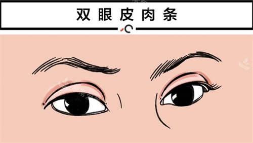 双眼皮肉条图 双眼皮肉条图