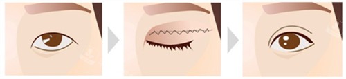 埋线双眼皮手术过程图解