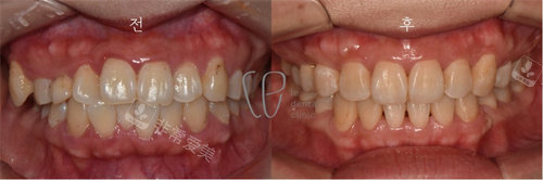 韩国Le牙科的牙齿矫正对比图