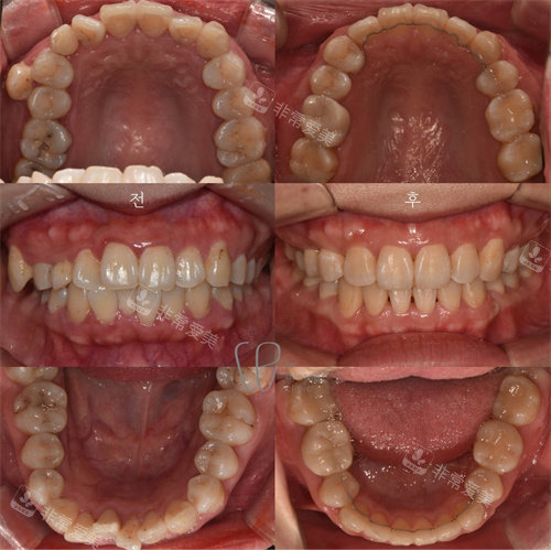 韩国Le牙科的牙齿矫正对比图