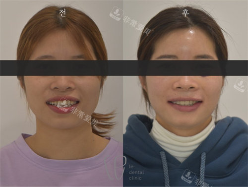 韩国Le牙科的牙齿矫正正面对比图