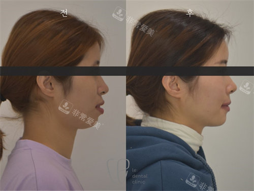 韩国Le牙科的牙齿矫正侧面对比图