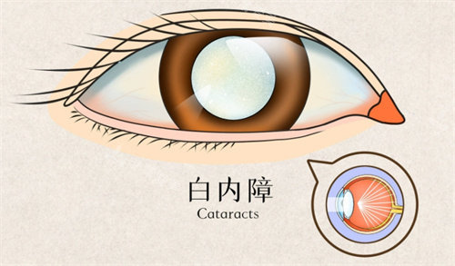 白内障动画图