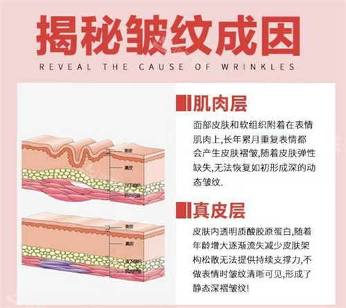 皱纹形成的原因图解