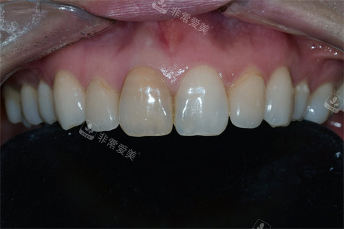 韩国SNOW牙科牙齿贴片+牙龈整形前