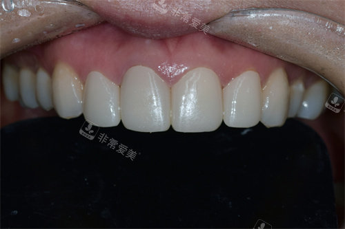 韩国SNOW牙科牙齿贴片+牙龈整形后