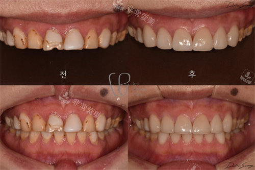 韩国le牙科前后对比图