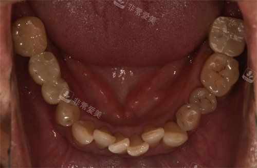 韩国le牙科术后全口照