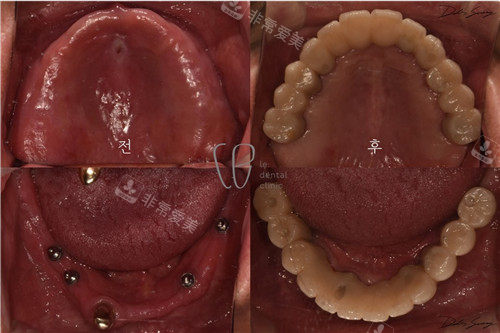 韩国le牙科全口种植牙图片