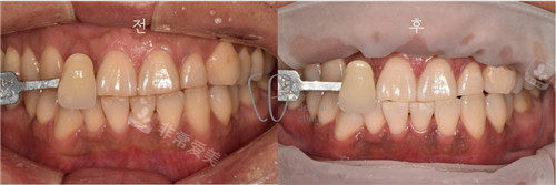 韩国le牙科做牙齿美白前后照片