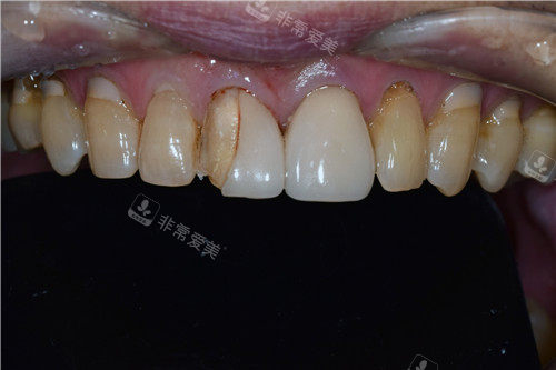 韩国snow牙科贴面修复前照片