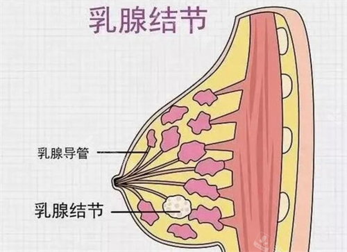 乳沟结节图片