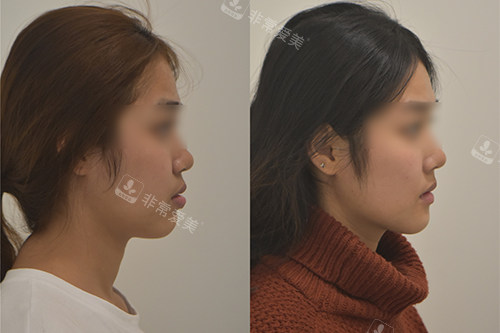 韓國(guó)Le牙科牙齒矯正前后對(duì)比圖