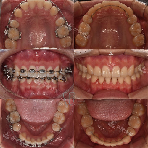 韩国le牙齿矫正对比图