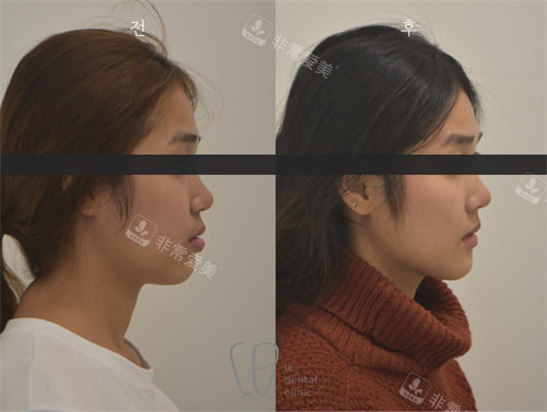 韩国le牙齿矫正前后面部对比图