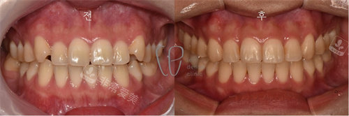 韩国le牙科牙齿对比图